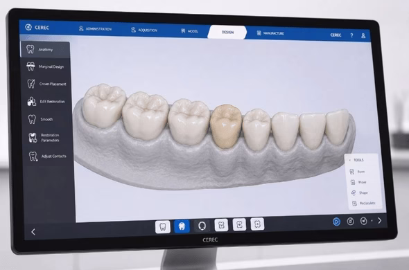Computerscherm met CEREC-software waarop een digitaal 3D-model van een gebit en een ontworpen tandrestauratie te zien zijn.